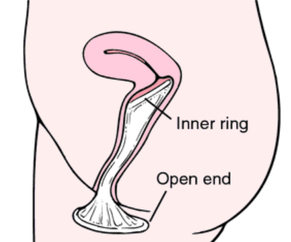 Female Condoms: What They Are and Where to Buy Them in Ireland